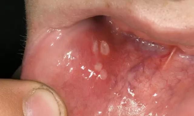 口腔溃疡反复发作一个月，补充了维生素也没有效果，这是什么原因图1