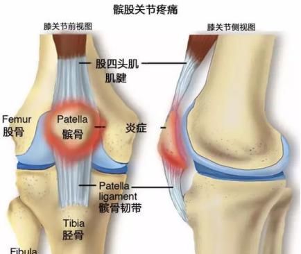 什么是髌骨软化症图2