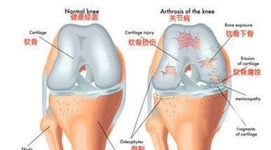 什么是髌骨软化症图8