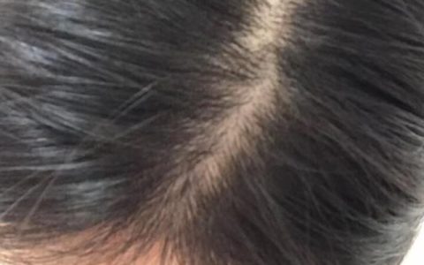 生发最好的方法，脱发严重,有什么好的方法防脱生发吗