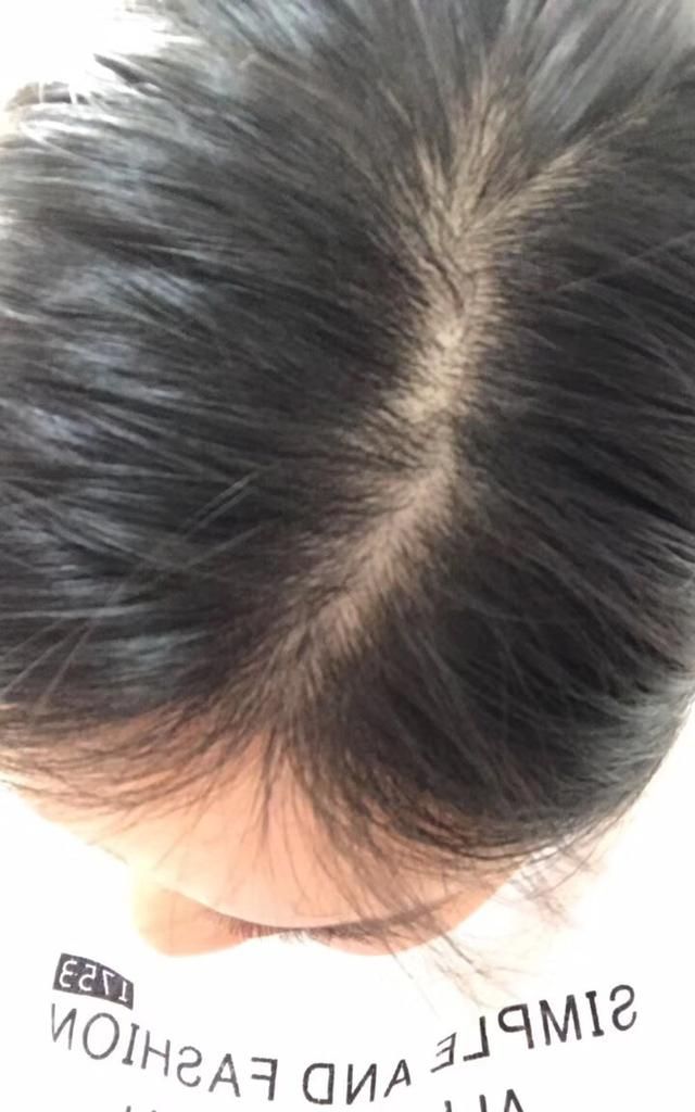 生发最好的方法，脱发严重,有什么好的方法防脱生发吗图1