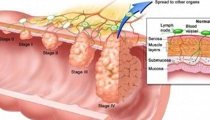 肠癌的饮食，肠癌患者在饮食方面应注意些什么呢图3