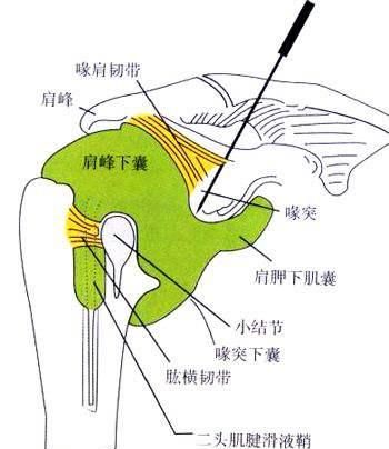 颈椎病做小针刀有危害图4