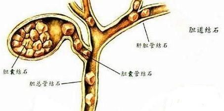 肝胆管结石症状，胆管结石怎么治疗最好的方法图1