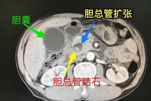 肝胆管结石症状，胆管结石怎么治疗最好的方法图2