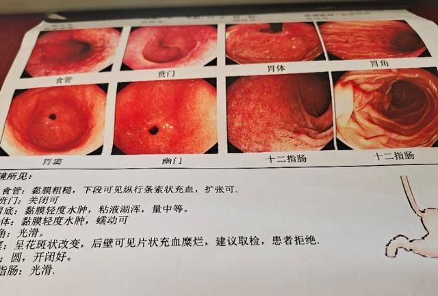 慢性浅表性胃炎饮食，浅表性胃炎怎样调理饮食图1