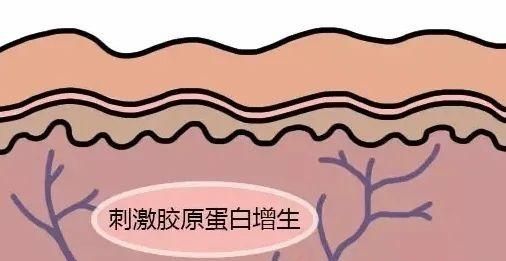 光子嫩肤效果好吗图9