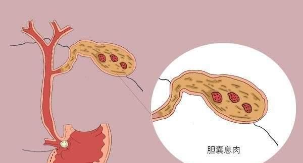 息肉是如何产生的，胃里息肉是如何产生的图2