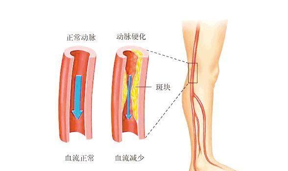 血管堵塞有什么好办法疏通图4