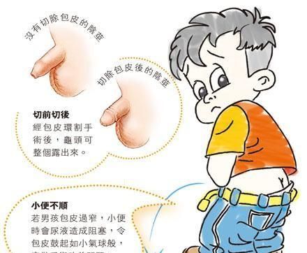 小孩几岁最适合做包皮手术图4