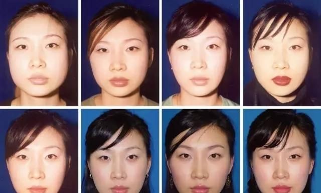 瘦脸针多长时间，打完瘦脸针多久可以看出效果图2