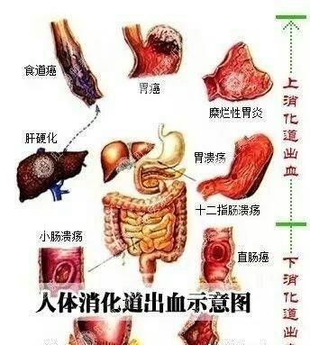 消化道出血的护理，什么是上消化道出血图1