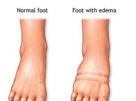 脚踝肿胀是什么原因引起的，脚踝水肿是什么原因引起的,怎么办图1