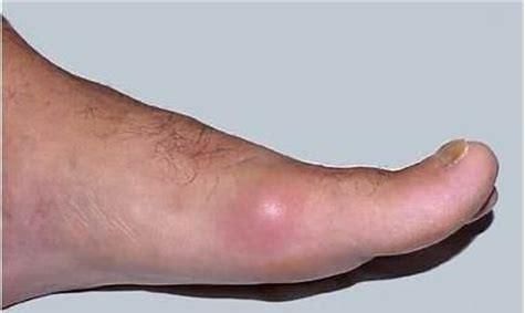 脚踝肿胀是什么原因引起的，脚踝水肿是什么原因引起的,怎么办图4