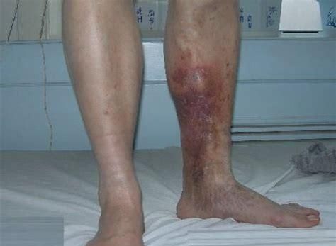 脚踝肿胀是什么原因引起的，脚踝水肿是什么原因引起的,怎么办图5