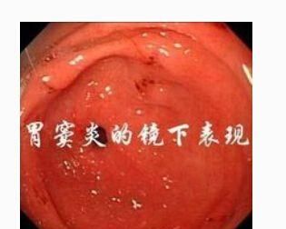 胃窦炎吃什么药，慢性胃窦炎怎么调养能好图4