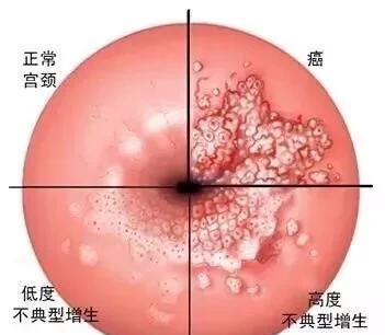 利普刀术后注意事项，利普刀椎切术后需要注意什么事项图1