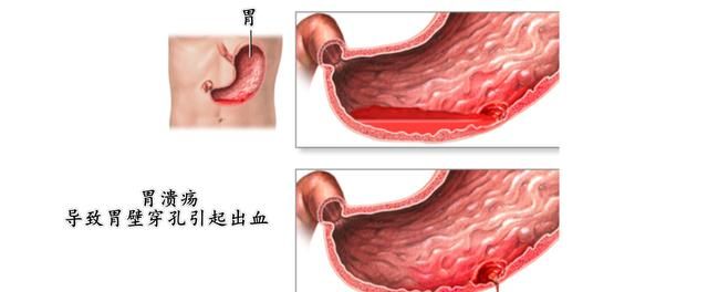 大便带血，大便拉出大量血怎么办图8