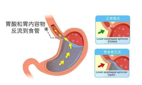 老胃病经常泛酸,打嗝,吃什么效果好呢图2