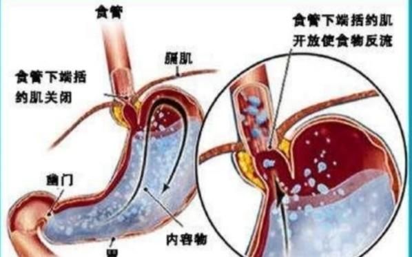 老胃病经常泛酸,打嗝,吃什么效果好呢图4