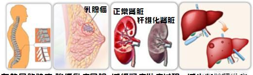 脂肪肝怎么食疗，脂肪肝病人晚餐要怎样饮食呢图6