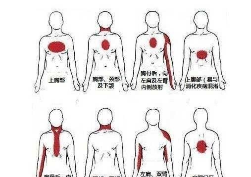 急性心肌梗塞的症状，心肌梗塞病人的症状有哪些图4