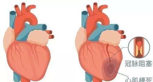 急性心肌梗塞的症状，心肌梗塞病人的症状有哪些图5