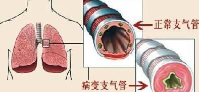 支气管肺炎的症状，支气管炎和肺炎的区别是什么图2