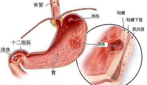 十二指肠溃疡症状，什么是十二指肠溃疡的好发部位图6