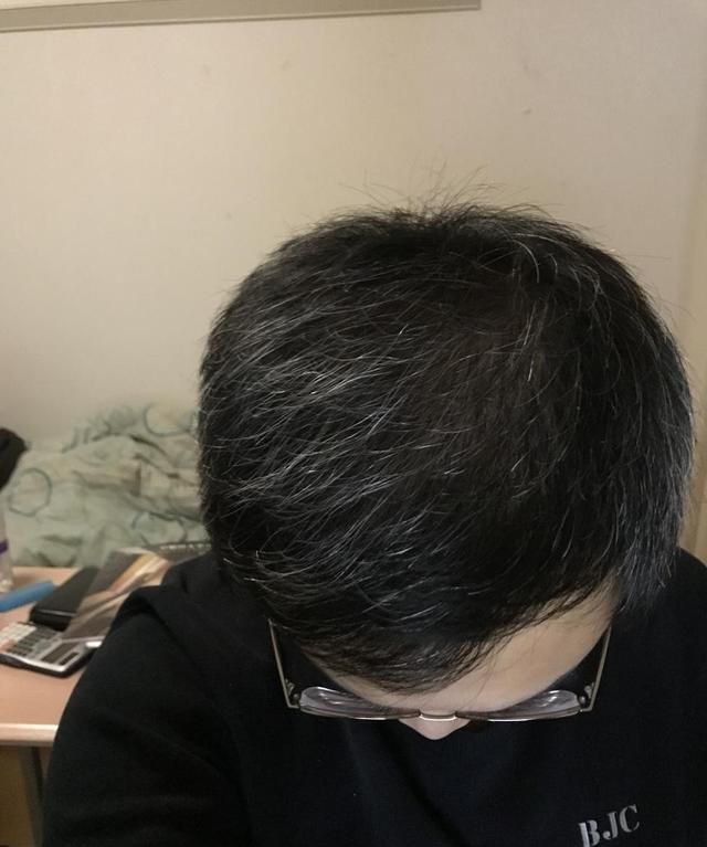生发养发黑发，怎样才能让白发变成黑发图1