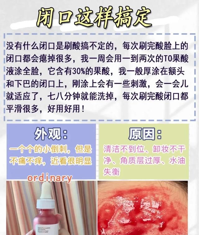 去粉刺印，怎样去粉刺和黑头粉刺图5