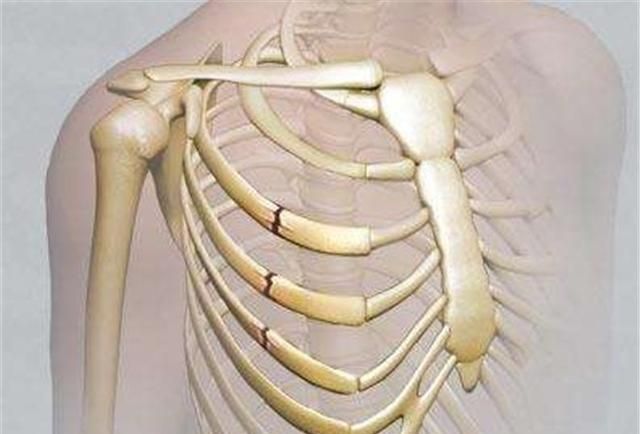 第二根肋骨，打断两根肋骨公安怎么处理图2