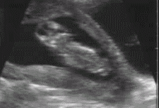 五个月胎儿彩超，五个月胎儿今天为什么不动了?图3