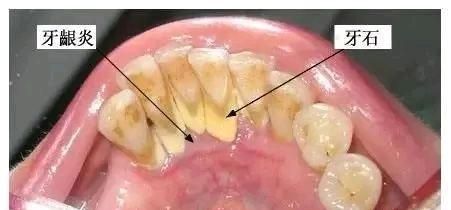 洗牙要多久，洗牙好吗?多久需要洗一次牙呢图10