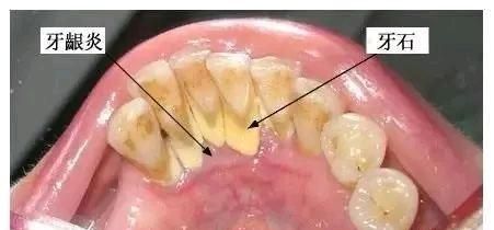 洗牙要多久，洗牙好吗?多久需要洗一次牙呢图10