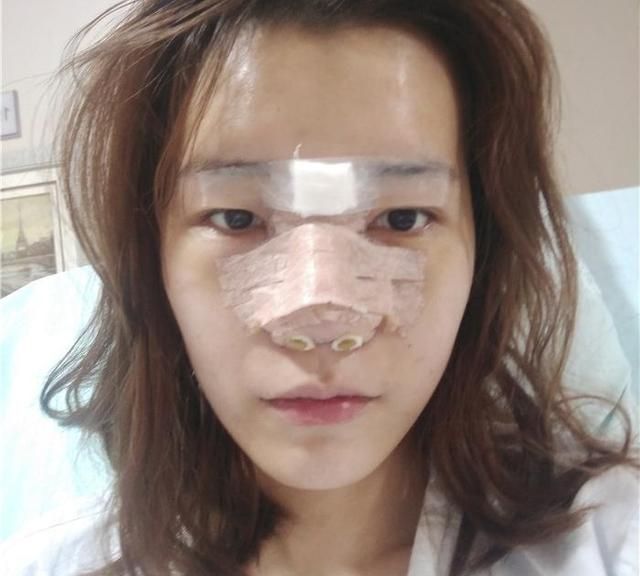 鼻子垫了会好看很多吗图2