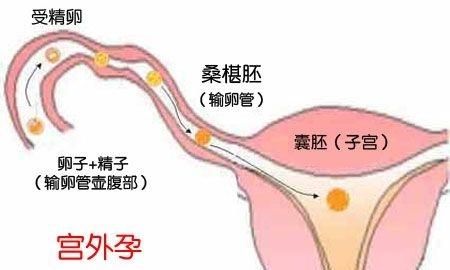 宫外孕打掉最佳时间图2