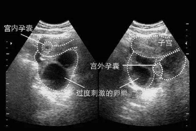 宫外孕打掉最佳时间图3