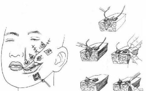 口腔颌面软组织清创术是什么手术