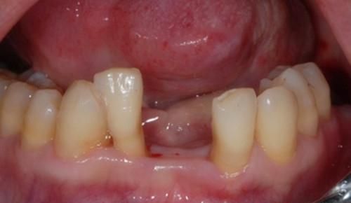 牙龈萎缩吃什么药，牙龈萎缩有什么药可以吃吗图6