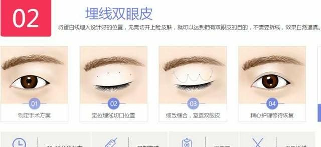 微创双眼皮多久恢复自然，做双眼皮多久可以完全恢复图7