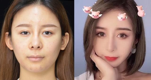 注射隆鼻有什么危害，隆鼻会有什么后遗症吗图1