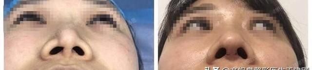 注射隆鼻有什么危害，隆鼻会有什么后遗症吗图2