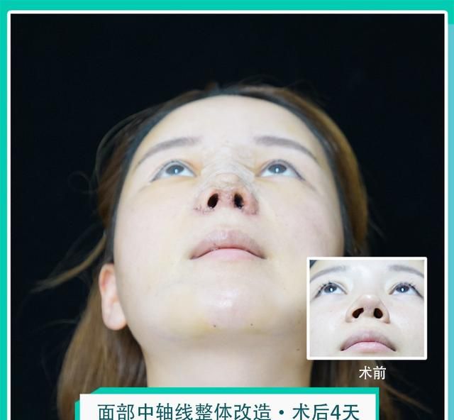 注射隆鼻有什么危害，隆鼻会有什么后遗症吗图3