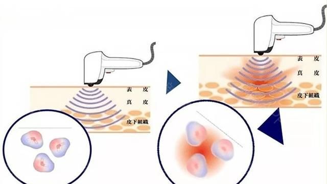 你做过哪些可以有效美容的医美项目图7