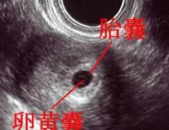 怀孕50天孕囊大小，怀孕60天,孕囊发育大小是怎样的呢图2