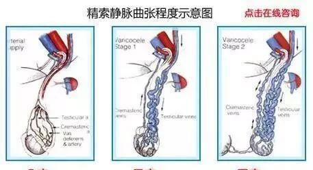 睾丸上长了一个小肉球硬硬的图4