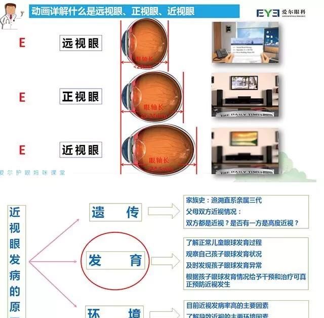 1000度高度近视，100度近视能恢复吗图1