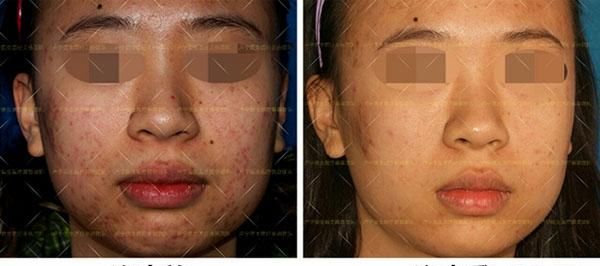 痘疤就是痘坑吗图1
