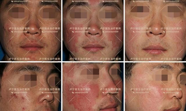 痘疤就是痘坑吗图2
